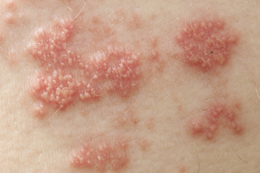 Understanding Shingles: What are the Symptoms, Treatment & Prevention